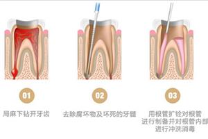 根管治疗